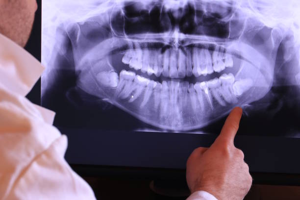 Best Emergency Wisdom Tooth Extraction in Algonac, MI